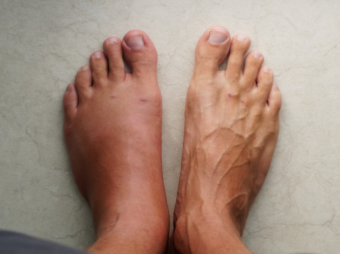 Why Are My Feet and Ankles Swollen? 6 Possible Reasons You Should Know