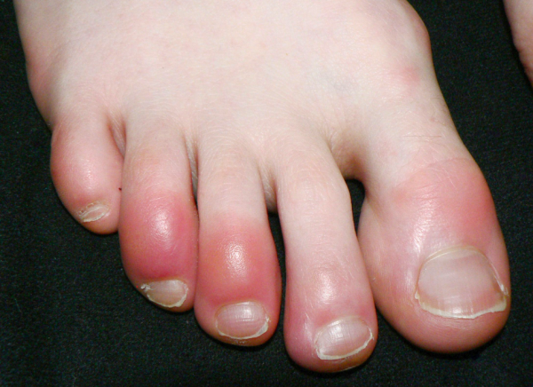 Chilblains on Your Toes: Why They Happen and How to Prevent Them This Winter
